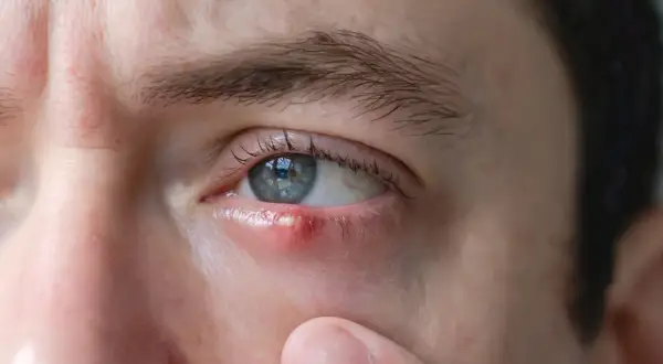 Widoczne objawy chorób powiek: zaczerwienienie i ropień na dolnej powiece. Zdjęcie pokazuje typowy symptom zapalenia.