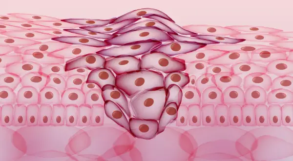 Abnormal cell growth, a concerning histologischer befund, shows invasive cells spreading through tissue layers.