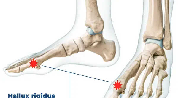 Anatomische Darstellung des Fußskeletts mit Hervorhebung des Gelenks am großen Zeh, das von Hallux rigidus betroffen ist.