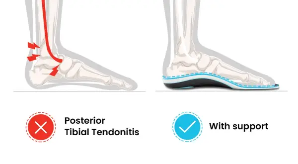 Vergleich: Entzündung des Tibialis posterior Sehnenansatzes (links, rot markiert) vs. Fuß mit Unterstützung (rechts, blaue Einlegesohle).
