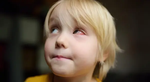 Mały chłopiec z blond włosami ma spuchnięte, zaczerwienione oko.