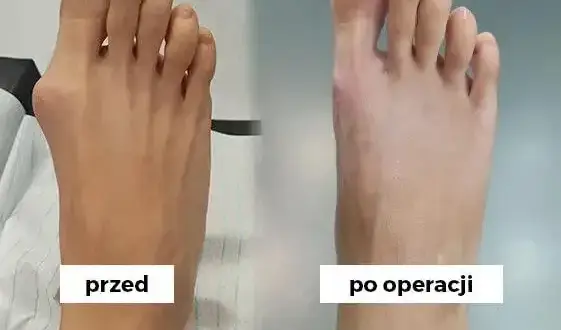 Jak długo boli po operacji haluksa? Pełen przewodnik rekonwalescencji