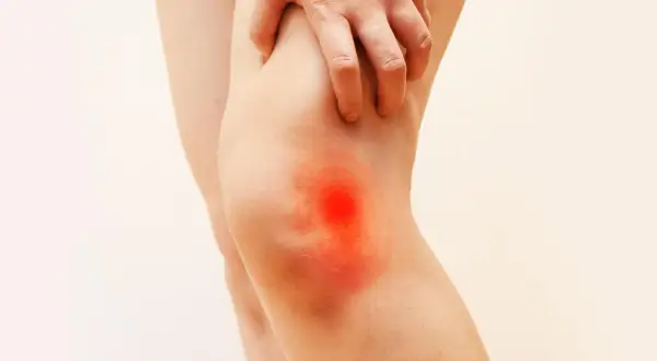 Mano che si gratta il ginocchio con un'area rossa e infiammata, sintomo di bruciore al ginocchio.