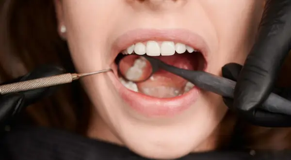 Dentysta bada zęby, szukając próchnicy przy dziąśle. Widoczne narzędzia stomatologiczne i otwarte usta pacjentki.