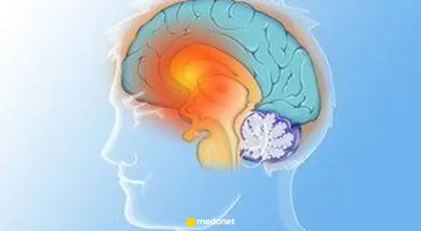 Ilustracja mózgu z zaznaczonymi obszarami, sugerującymi problemy neurologiczne, jak pląsawica choroba.