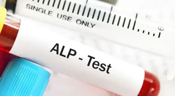 Podwyższona fosfataza alkaliczna: Co oznacza? Przyczyny i kroki