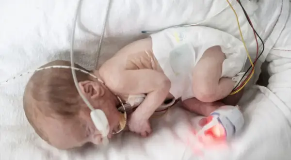 Ein winziges Baby, geboren in der 18. SSW, liegt in einem Inkubator, verbunden mit medizinischen Geräten.