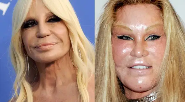 Donatella Versace i Jocelyn Wildenstein – które gwiazdy przeszły nieudane operacje plastyczne twarzy w Polsce?