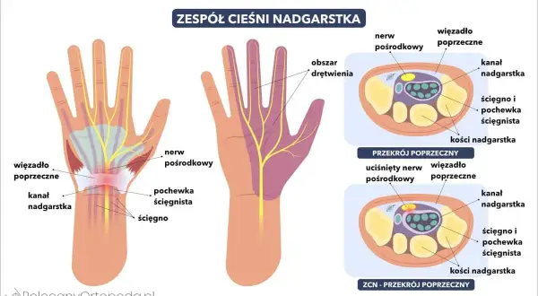Mrowienie ręki? Cieśnia nadgarstka: Kto diagnozuje, jak leczyć?