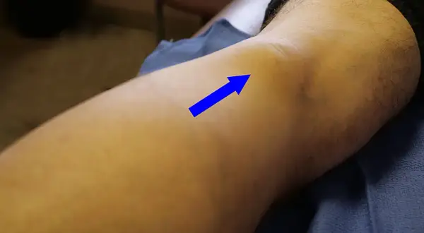 Ginocchio con freccia blu che indica un'area gonfia, possibile muscolo popliteo infiammato. Esercizi per il recupero.
