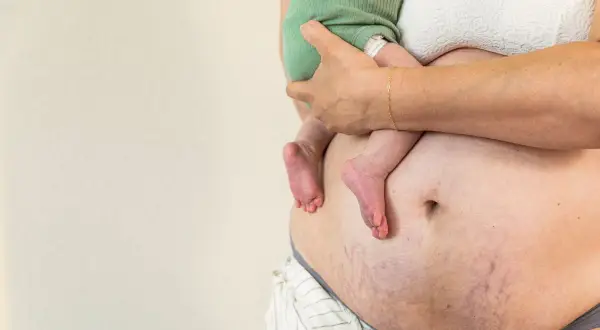 Ciało po ciąży z widocznymi rozstępami, trzymające dziecko. Matka w białym biustonoszu i luźnych spodniach.