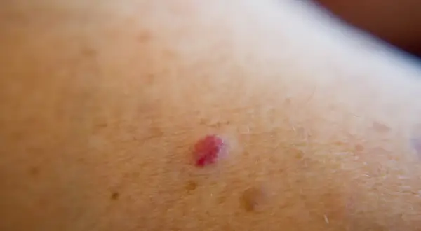 Mały, czerwony naczyniak wiśniowy na skórze, otoczony drobnymi włoskami i innymi zmianami skórnymi.