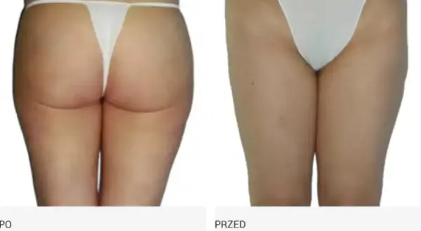 Endermologia: Jak często? Odstępy (2-3x/tydz.) dla trwałych efektów