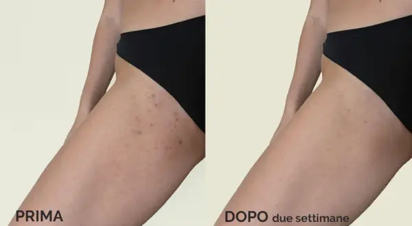 Prima e dopo due settimane: come depilare l'inguine con la lametta per una pelle liscia e senza irritazioni.