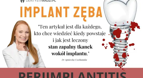 Dowiedz się, jak wyleczyć stan zapalny tkanek wokół implantu zęba. Grafika przedstawia implant zęba z krwią i uśmiechniętą dentystkę.