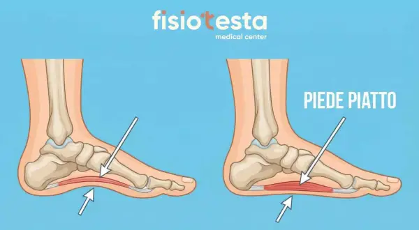 Confronto tra un piede normale e un piede piatto, evidenziando la pronazione del piede e l'appiattimento dell'arco plantare.