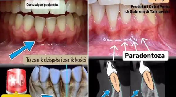 Zdjęcie przedstawia problemy z dziąsłami i kością szczęki, w tym zanik dziąseł i kości oraz paradontozę.
