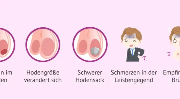 Illustration zeigt einen Hoden mit einem Knubbel, veränderte Hodengröße, einen schweren Hodensack, Schmerzen in der Leistengegend und empfindliche Brüste.