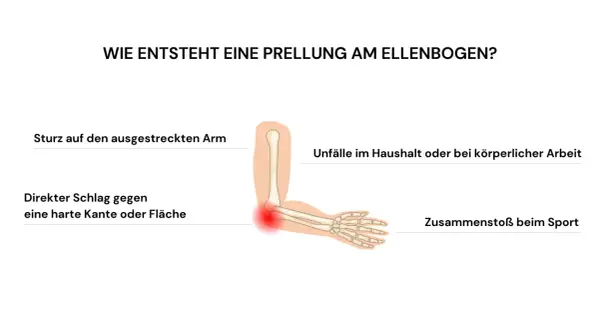Illustration zeigt, wie **Prellungen nach Sturz** am Ellenbogen entstehen: durch Sturz auf ausgestreckten Arm, Schlag gegen harte Kante, Unfälle oder Sport.