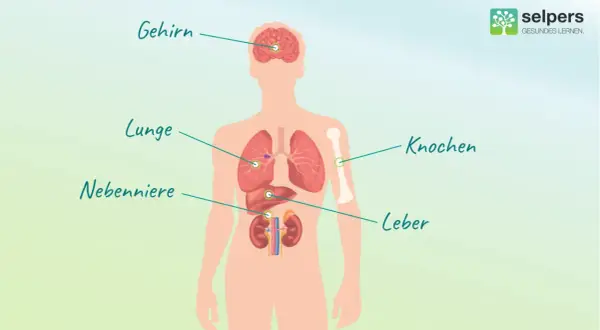 Illustration zeigt menschlichen Körper mit markierten Organen: Gehirn, Lunge, Nebenniere, Knochen, Leber. Mögliche Metastasierungsorte bei Lungenkrebs.