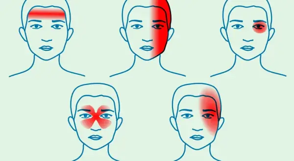Ilustracje pokazują różne lokalizacje bólu głowy przy nerwicy: czoło, skronie, okolice oczu, cała głowa.