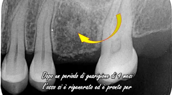 Radiografia dentale mostra rigenerazione ossea dopo displasia cemento ossea, pronta per impianto.