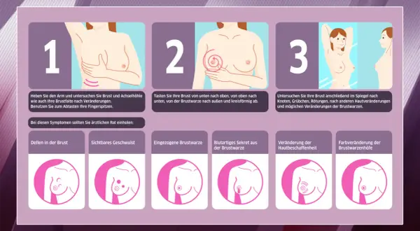 Illustrationen zeigen Brustuntersuchung. Ein sichtbares Geschwulst kann ein Brustkrebs-Knoten sein. Achten Sie auf Veränderungen.