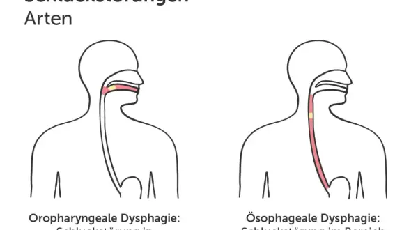 Illustrationen zeigen zwei Arten von Dysphagie: Oropharyngeale Dysphagie (Mund/Rachen) und Ösophageale Dysphagie (Speiseröhre).