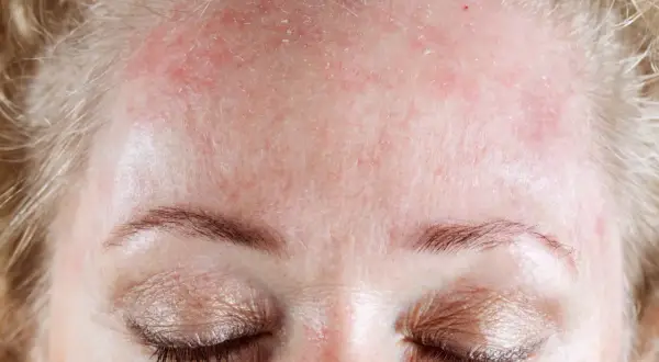 Gros plan sur le front d'une femme aux cheveux blonds, montrant une peau rouge et irritée, avec des zones de **peau qui pèle** près de la racine des cheveux.
