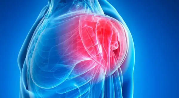 Anatomical illustration of a shoulder with inflamed bursa highlighted in red.