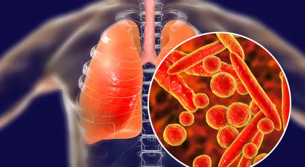 Ilustracja płuc człowieka z powiększeniem bakterii Mycoplasma pneumoniae.