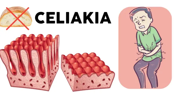 Celiakia, alergia, NCNG: co gluten robi w organizmie? Ekspert wyjaśnia