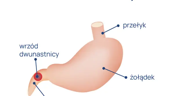Jakie są objawy wrzodu dwunastnicy? Poznaj niebezpieczne sygnały