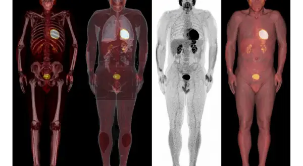 Vier medizinische Bilder zeigen den menschlichen Körper. Die PET/CT-Nachteile sind hier nicht ersichtlich, nur die Darstellung von Organen und Knochen.