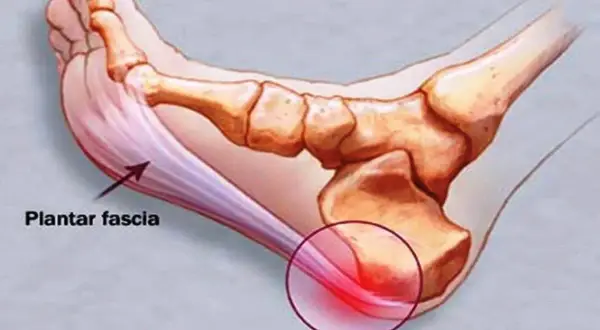 Illustration av fotens anatomi som visar plantar fascia och smärtsamma triggerpunkter vid plantar fasciitis.