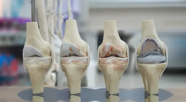 Modèles de genoux montrant l'évolution de l'arthrose et une prothèse. Ces images illustrent le succès de la prothèse du genou.