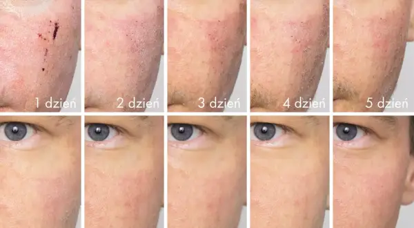 Post-laserowa regeneracja skóry: od zaczerwienienia i strupków (dzień 1) do stopniowego wygładzenia i poprawy cery (dzień 10).