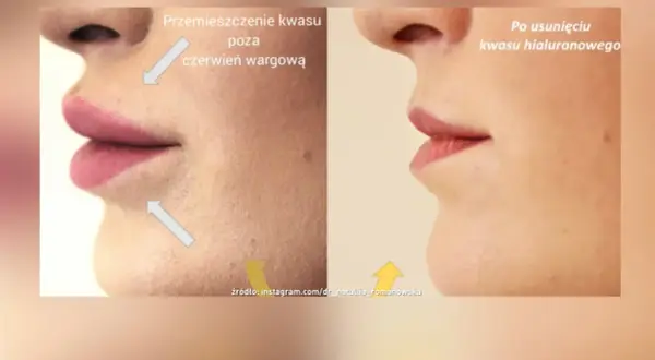 Przed i po usunięciu kwasu hialuronowego z ust. Pokazuje efekt powiększania ust metodą na płasko i jego cofnięcie.
