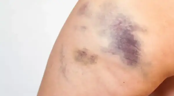Große, schnell blaue Flecken auf dem Bein einer Frau nach einem Sturz.