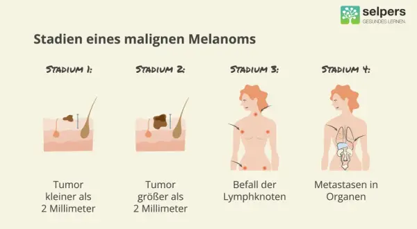 Illustrationen zeigen Stadien eines malignen Melanoms: Tumorgröße, Lymphknotenbefall und Metastasierung. Früherkennung ist wichtig für die schwarzer hautkrebs behandlung.