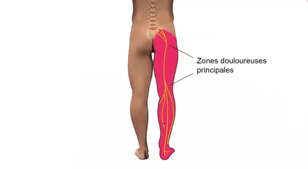 Schéma montrant les zones douloureuses principales d'une jambe, suggérant un mal aux cuisses la nuit.
