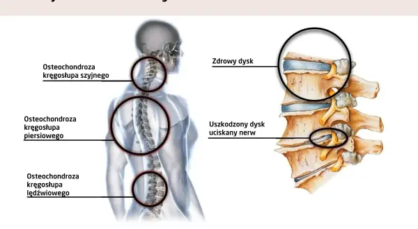 Ilustracja pokazuje ucisk na nerw szyjny objawy. Widoczna osteochondroza kręgosłupa szyjnego, piersiowego i lędźwiowego.