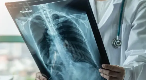 Lekarz analizuje RTG klatki piersiowej, szukając oznak odmy płucnej. Czy można umrzeć? Szybka diagnoza ratuje życie.