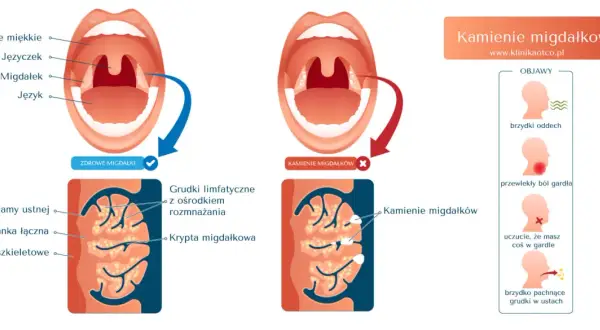 Ilustracja pokazuje zdrowe migdałki i migdałki z kamieniami. Kamienie migdałkowe mogą powodować brzydki oddech i ból gardła.
