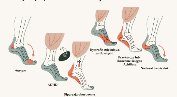 Ilustracja pokazuje, jak 10-letnie dziecko chodzi na palcach z powodu autyzmu, ADHD, dystrofii mięśniowej, przykurczu ścięgna Achillesa lub nadwrażliwości dotykowej.