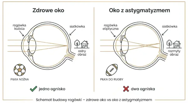 Schemat oka zdrowego i z astygmatyzmem, pokazujący różnicę w ogniskowaniu światła.