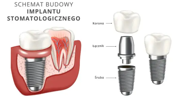 Schemat budowy implantu stomatologicznego: śruba, łącznik, korona. Implant zęba NFZ to rozwiązanie dla pięknego uśmiechu.