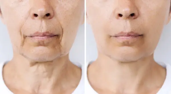 Comparación de piel: antes y después de un tratamiento que podría afectar el "ozempic face", mostrando reducción de arrugas y flacidez.
