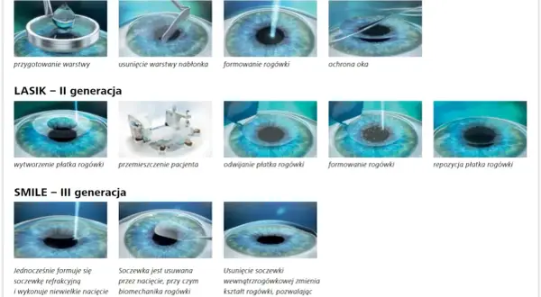 Ilustracje pokazują etapy korekcji wzroku laserem: PRK, LASIK i SMILE. Każda metoda poprawia widzenie.