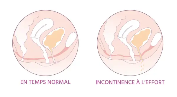 Schéma comparant le périnée féminin normal et en cas d'incontinence à l'effort. L'irritation périnée femme peut être liée à ces fuites.